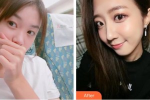 襄陽(yáng)海峽醫(yī)療美容門診部郭永軍整形價(jià)格表附鼻部綜合案例展示