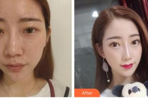 襄陽(yáng)華美醫(yī)療美容門診部張輝整形價(jià)格表附假體隆鼻案例展示