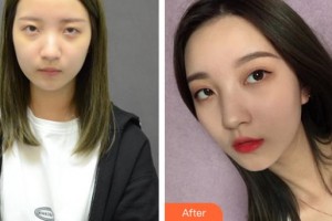 襄陽美嘉伊整形美容醫(yī)院馬行整形價格表附自體脂肪全臉填充案例展示