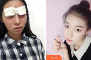 襄陽愛爾眼科醫(yī)院趙建敏整形價格表附切開雙眼皮案例展示