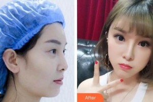 襄陽愛爾眼科醫(yī)院文呈呈整形價格表附眼部綜合案例展示