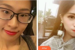 襄陽愛爾眼科醫(yī)院程秀著整形價格表附切開雙眼皮案例展示