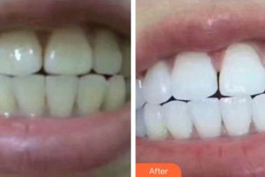 襄陽牙牙口腔門診部楊坤整形價格表附美白貼片案例展示