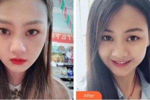 襄陽維樂口腔門診部謝碧亨整形價格表附牙齒隱形矯正案例展示