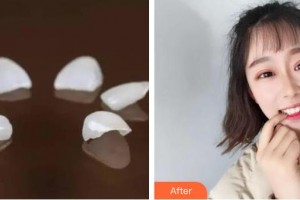 襄陽時代口腔醫(yī)院任旭東整形價格表附美白貼片案例展示