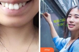 襄陽時代口腔醫(yī)院趙恒整形價格表附金屬托槽矯正案例展示