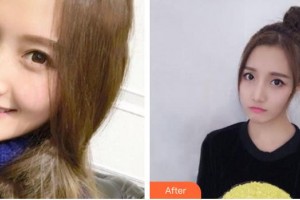 襄陽市第一人民醫(yī)院李德勝整形價格表附埋線提升案例展示