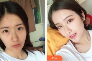 襄陽市第一人民醫(yī)院吳小軍整形價格表附拉皮手術(shù)提升案例展示