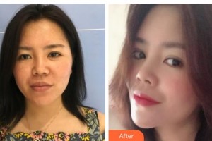 襄陽市第一人民醫(yī)院王慧整形價格表附埋線提升案例展示