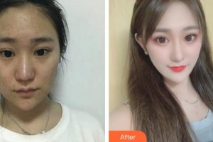 襄陽市第一人民醫(yī)院李運安整形價格表附激光美膚激光案例展示