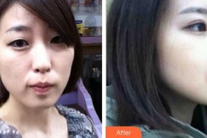 襄陽市第一人民醫(yī)院劉剛整形價格表附埋線提升案例展示