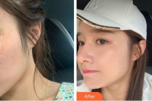 襄陽市第一人民醫(yī)院陳勇整形價格表附激光美膚激光案例展示