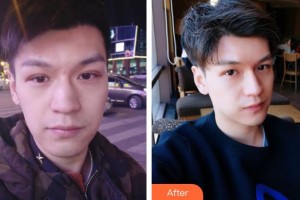 襄陽市第一人民醫(yī)院殷暉整形價格表附埋線提升案例展示