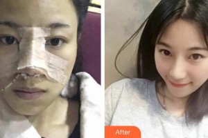 恩施華美整形美容門診部王玉榮整形價格表附鼻部綜合案例展示