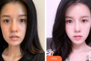 恩施華美整形美容門診部謝雙靈整形價格表附鼻部綜合案例展示