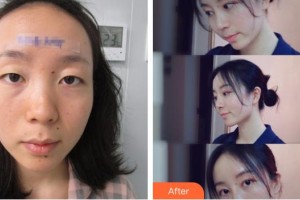 恩施華美整形美容門診部張鶴鳴整形價格表附假體隆鼻案例展示