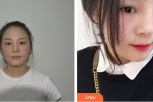 恩施中韓整形美容醫(yī)院趙東升整形價格表附隆鼻案例展示