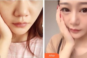 恩施州中心醫(yī)院燒傷整形科田代雄整形價格表附鼻部綜合案例展示