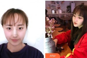 恩施華美整形美容門診部方媛整形價格表附鼻部綜合案例展示