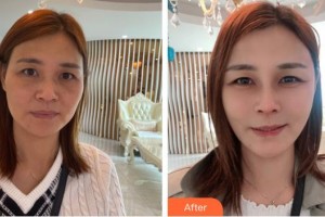 恩施華美整形美容門診部高海燕整形價格表附肋軟骨隆鼻案例展示