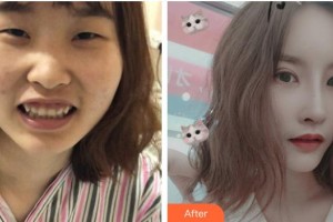 恩施愛爾眼科醫(yī)院戴守整形價格表附眼部綜合案例展示