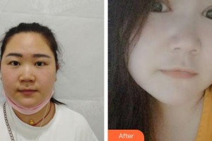 恩施華美整形美容門診部韓金柱整形價格表附切開雙眼皮案例展示