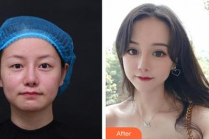 恩施慧益眼科醫(yī)院鮮光軍整形價格表附眼部綜合案例展示