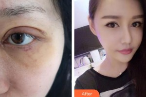 恩施慧益眼科醫(yī)院俞曉藝整形價格表附眼部綜合案例展示