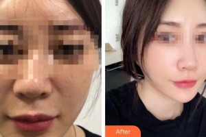 仙桃友好醫(yī)學美容醫(yī)院胡霜紅整形價格表附埋線提升案例展示