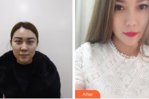 仙桃博美醫(yī)療美容醫(yī)院王英明整形價格表附埋線提升案例展示