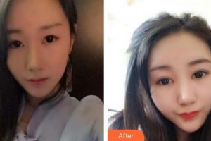 潛江白衣天使醫(yī)療美容診所于濤整形價格表附眼部綜合案例展示