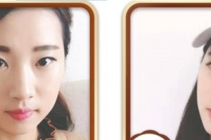 天門愛爾眼科醫(yī)院王智琦整形價格表附眼部綜合案例展示