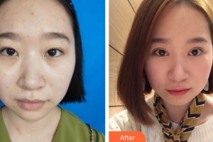 天門愛爾眼科醫(yī)院梁南進(jìn)整形價格表附定點(diǎn)雙眼皮案例展示