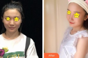 天門愛爾眼科醫(yī)院周君平整形價格表附眼部綜合案例展示