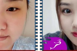 天門明保眼科醫(yī)院付德華整形價格表附眼部綜合案例展示