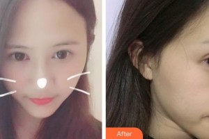 牡丹江紅旗醫(yī)院整形美容科趙曉崢整形價格表附眼部綜合案例展示