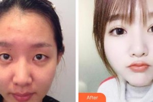 牡丹江第一人民醫(yī)院燒傷科姜月虎整形價格表附眼部綜合案例展示