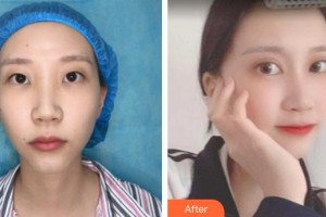 牡丹江美神醫(yī)療美容診所王玉梅整形價格表附眼部綜合案例展示