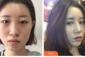 牡丹江鄒倩醫(yī)療美容診所鄒倩整形價格表附切開雙眼皮案例展示