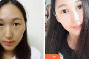 伊春王霞醫(yī)療美容診所王霞整形價格表附切開雙眼皮案例展示