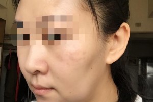 贛州華美醫(yī)療美容門診部劉兵整形價(jià)格表附面部年輕化案例展示