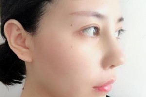 贛州華美醫(yī)療美容門診部覃潔敏整形價(jià)格表附隆鼻案例展示