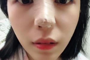 贛州華美醫(yī)療美容門診部吳曉宇整形價(jià)格表附隆鼻案例展示