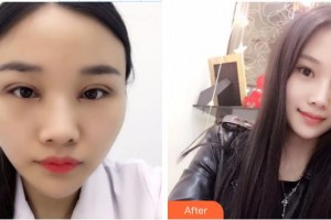 宜春學(xué)院整形美容醫(yī)院彭慶星整形價格表附眼部綜合案例展示