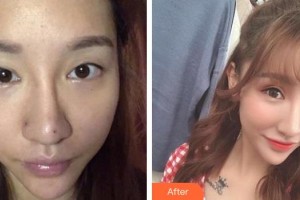 宜春艾萊芙醫(yī)療美容門診部付曉紅整形價格表附切開雙眼皮案例展示