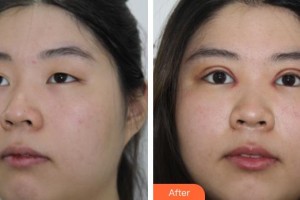 宜春韓美醫(yī)療美容門診部余志亮整形價格表附切開雙眼皮案例展示