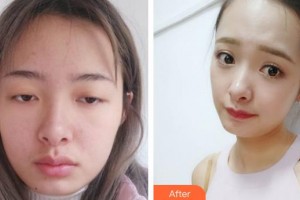 宜春瑞麗整形美容門診部趙杰發(fā)整形價格表附切開雙眼皮案例展示
