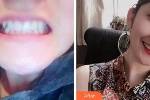 宜春天澤美容醫(yī)院周玲整形價格表附牙齒陶瓷矯正案例展示