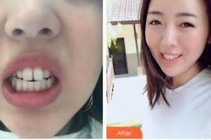 宜春伊美美容整形外科診所鄒建英整形價格表附隱形托槽矯正案例展示