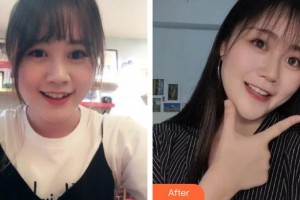 宜春韓美醫(yī)療美容門診部河范峻整形價格表附金屬托槽矯正案例展示